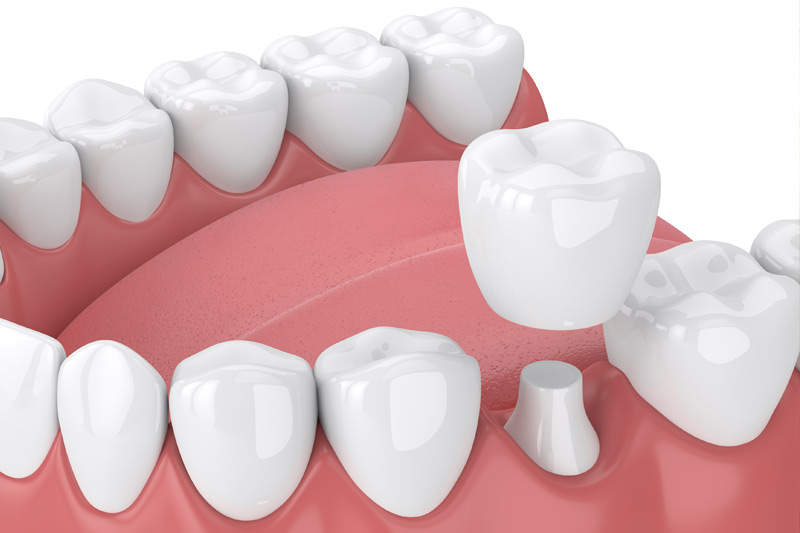 Dental Crowns in Natick