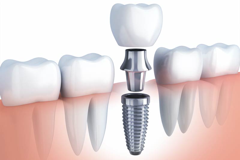 Implants Dentist in Natick